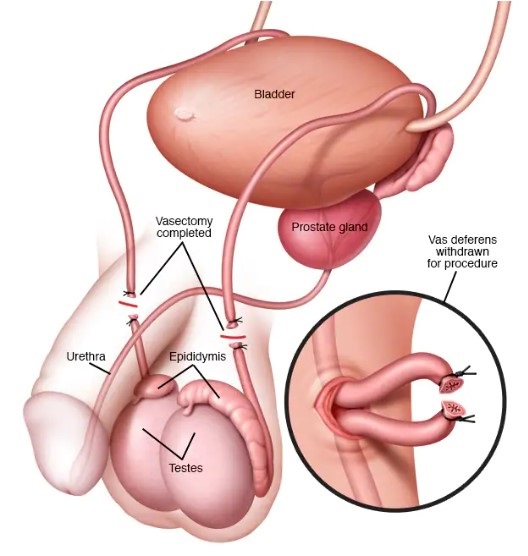 Does a Vasectomy Increase Testosterone