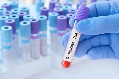 Does Progesterone Supplementation Increase C-Reactive Protein? A Comprehensive Guide